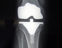 Infección de prótesis articulares (IPA)