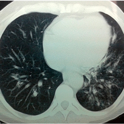 Pneumocistosis pulmonar en paciente con trasplante renal