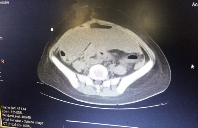 Infecciones en Postoperatorio de gastrectomía oncológica asociada a quimioterapia hipertérmica intra-peritoneal