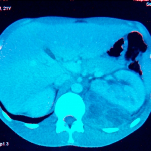 Abscesos del músculo psoas por SAMR-com