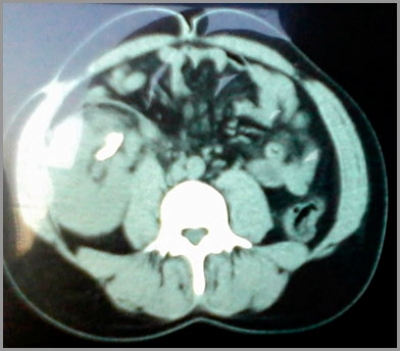 Sepsis nefrourológica por BGN productor de carbapenemasas NDM