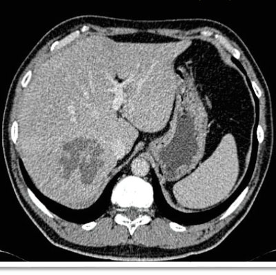 Absceso hepático