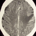 Leucoencefalopatia multifocal progresiva