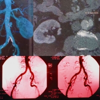 Bacteriemia a Salmonella choleraesuis complicada con aneurisma micótico a nivel de la aorta abdominal infrarrenal y compromiso pulmonar