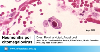 Neumonitis por Citomegalovirus