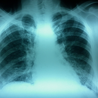 Tuberculosis en trasplante renal