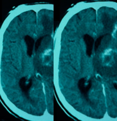 Toxoplasmosis en paciente infectado por el VIH 