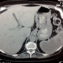 Abscesos esplénicos