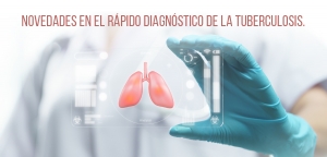 Diagnóstico de Tuberculosis utilizando las nuevas técnicas moleculares rápidas en Uruguay.