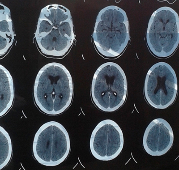 Trastornos neurocognitivos (TNC) asociados a VIH