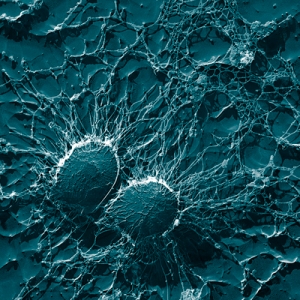 Endocarditis infecciosa por Staphylococcus aureus meticilino resistente